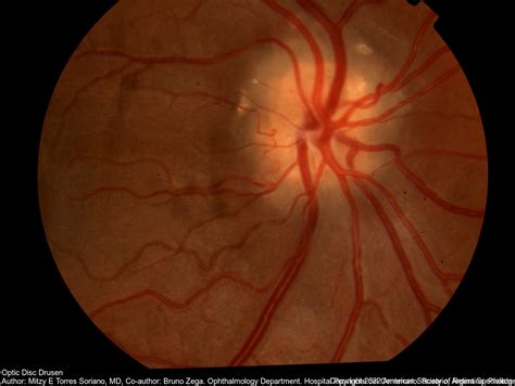 Optic Nerve Drusen