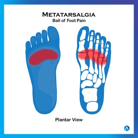 Pain On Ball Of Foot