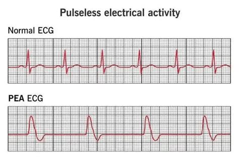 Pea Cardiac Arrest