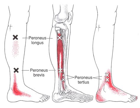 Peroneus Longus Pain