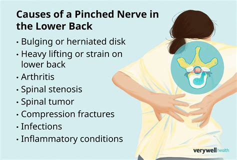 Pinched Nerve Lower Back