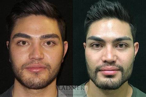Plastic Surgery For Men Face