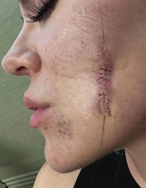 Plastic Surgery Stitches On Face