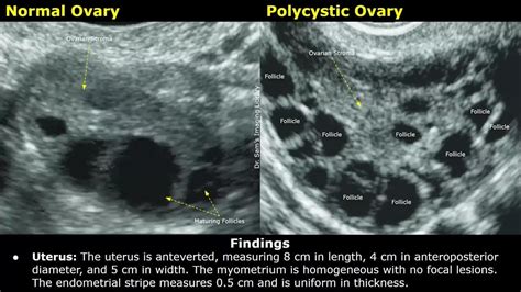Polycystic Ovary Ultrasound Images