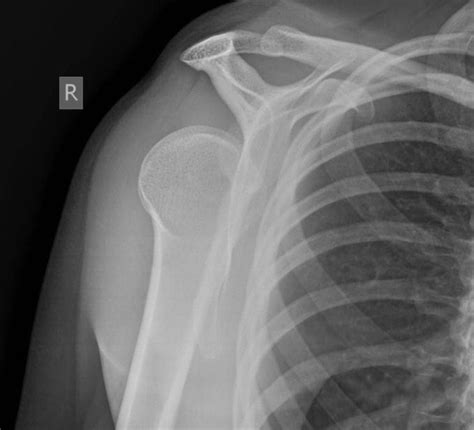 Posterior Shoulder Dislocation