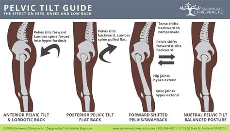 Posterior Tilt Pelvic