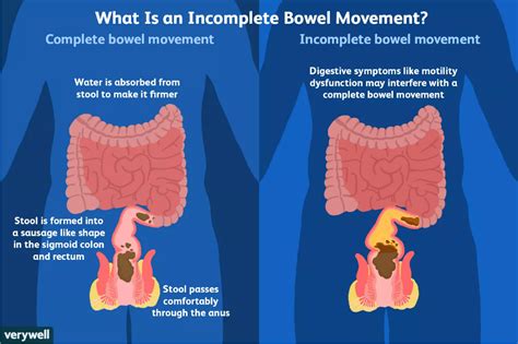 Problems With Bowel Movements