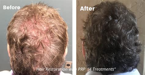 Prp Hair Restoration