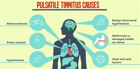 Pulsatile Tinnitus Causes