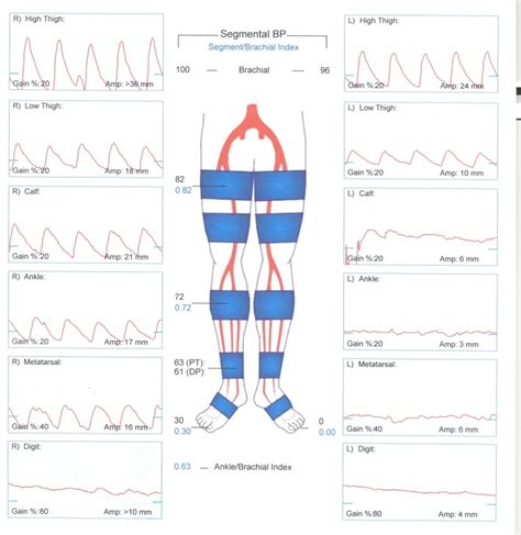 Pulse Volume Recording