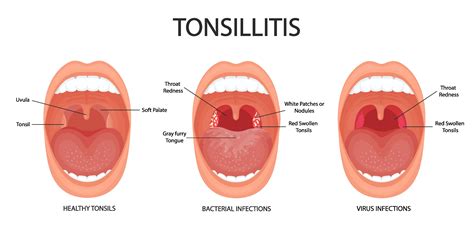 Purpose Of Tonsils