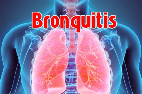 Que Es Bronquitis