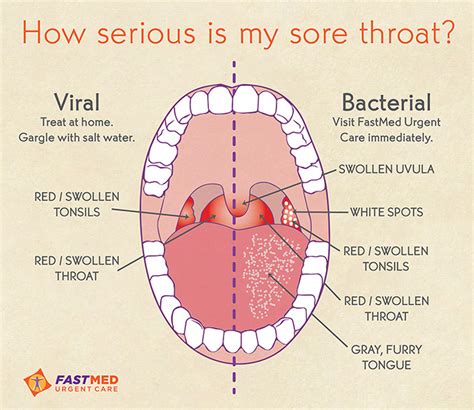 Recurring Sore Throat