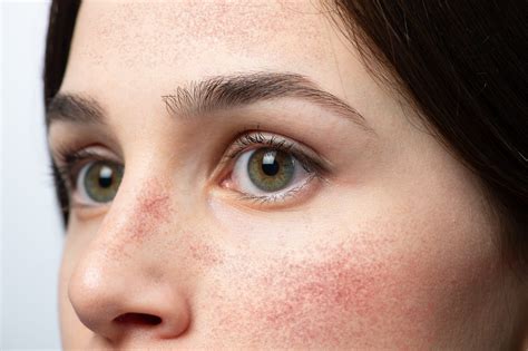Red Patches On Cheeks