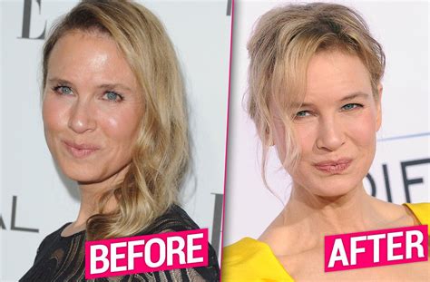 Renee Zellweger Face Plastic Surgery