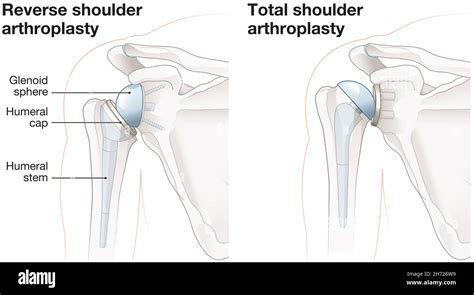 Reverse Shoulder Arthroplasty