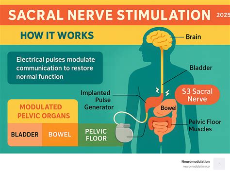 Sacral Nerve Stimulator