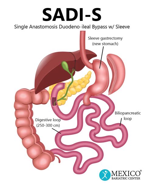 Sadi Bariatric Surgery