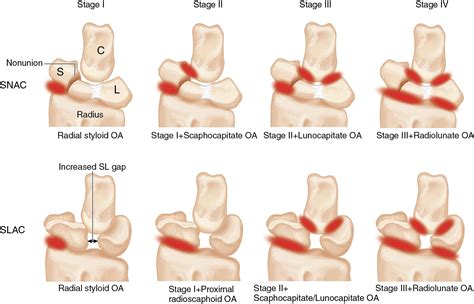 Scaphoid Nonunion Advanced Collapse