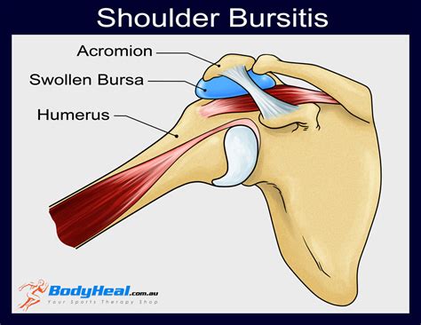 Shoulder Pain Bursa Sac