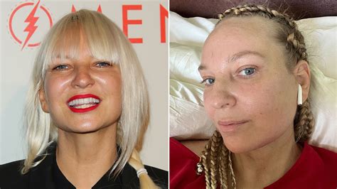 Sia Face Surgery