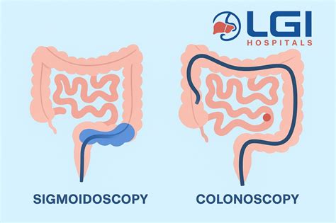 Sigmoidoscopy Vs Colonoscopy
