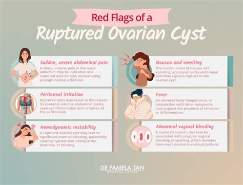 Signs Of Ovarian Cyst Rupture