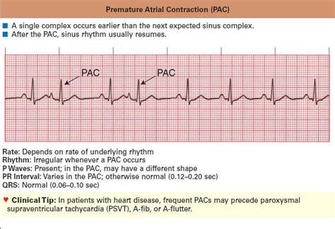 Sinus Rhythm With Pac