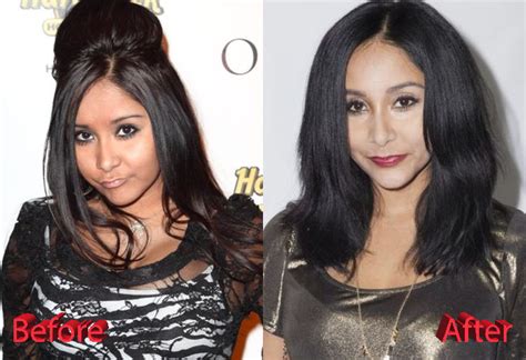Snooki Face Surgery
