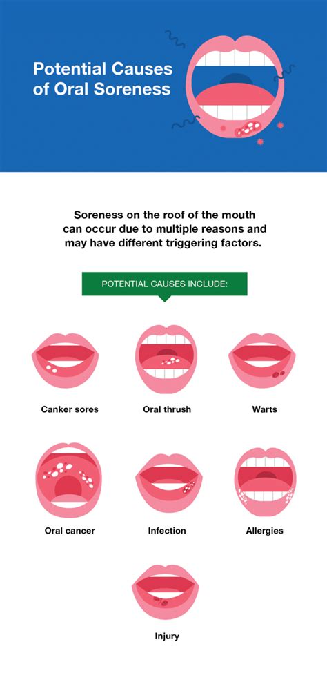 Sore On Roof Of Mouth