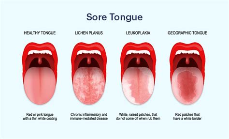 Sore Tongue At The Back