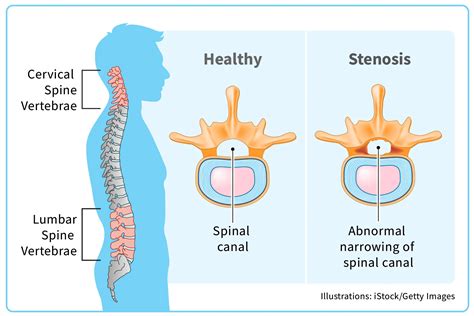 Spinal Stenosis Selfcare
