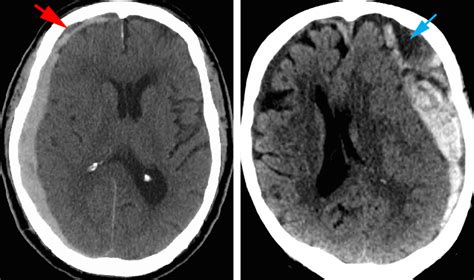 Subdural Hemorrhage Ct Images