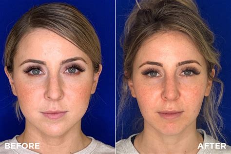 Surgery To Get Rid Of Face Fat