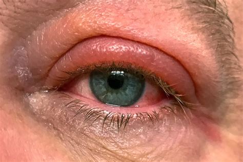 Swollen Upper Eyelid