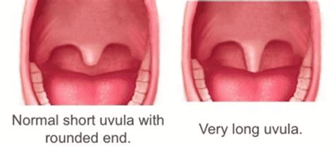 Swollen Uvula From Snoring