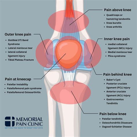 Tenderness Above Knee Cap