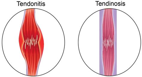 Tendonitis Vs Tendinosis