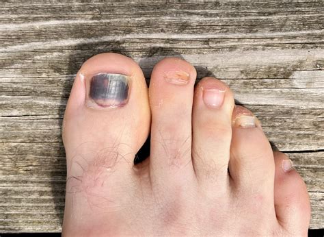 Toe Nails Becoming Black