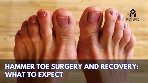 Toe Surgery Hammertoe