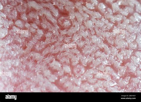 Tongue Inflammation Taste Buds