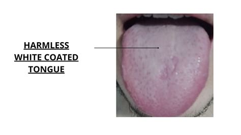 Tongue White Coating