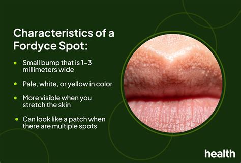 Topical Creams For Fordyce Spots
