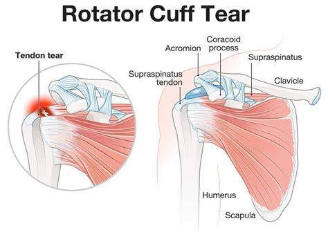 Torn Rotator Cuff Pain