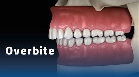 Treatment For Overbite Teeth