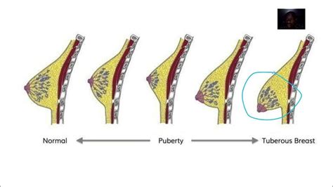 Tuberous Breast Deformity