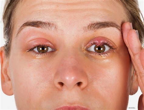 Tumor In Eye Treatment