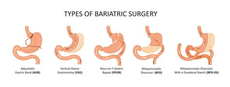 Types Of Bariatric Surgery