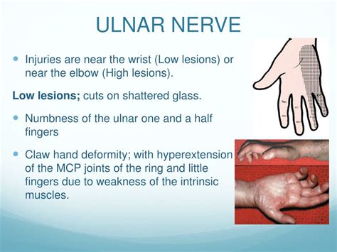 Ulnar Nerve Damage Symptoms