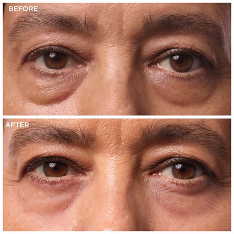 Under Eye Bag Treatment